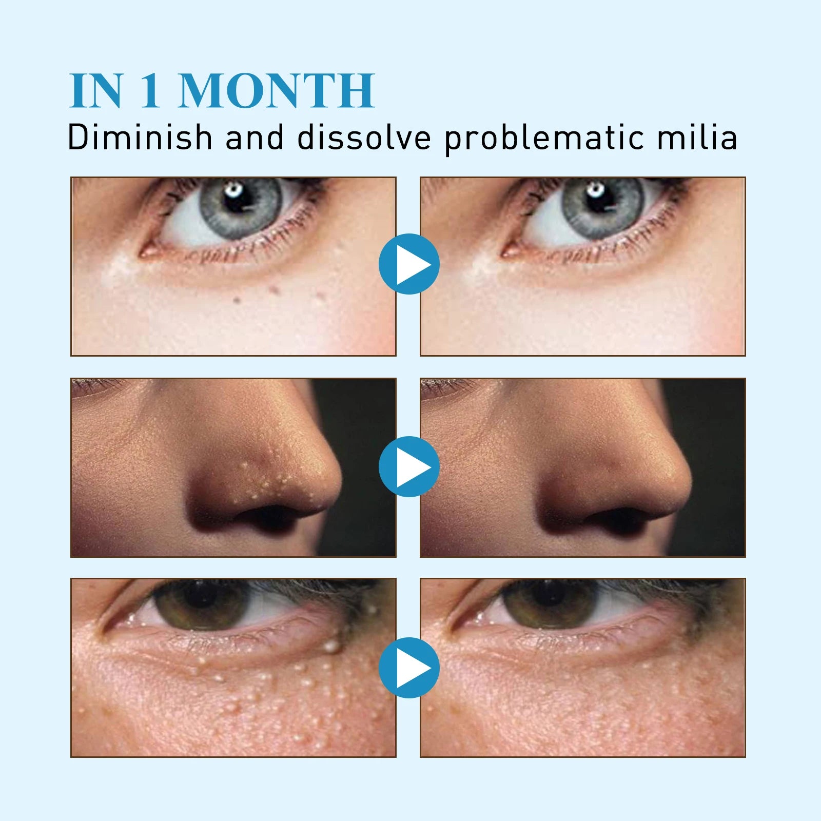 144pcs Skin Care Patches Reduce Milia